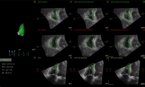 3d rv volume calculation